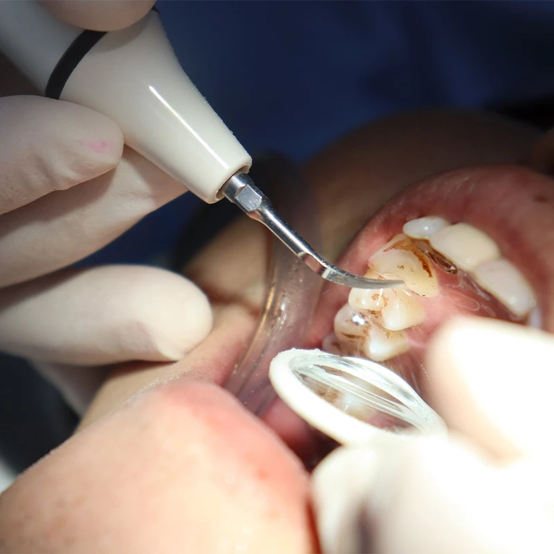 スケーラーハンドピースチューブケーブル歯科用超音波ユニットフ - Teeth Whitening Youtube のレビューと価格