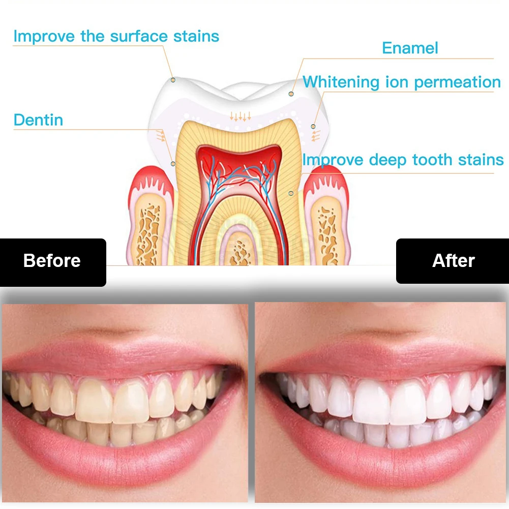 歯科歯ホワイトニングキットミニ 16 LED コールドライト - Teeth Whitening Pen のレビューと価格